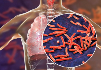 32 случая туберкулёза за год